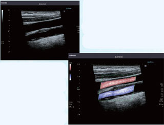 頸動脈超音波検査の写真